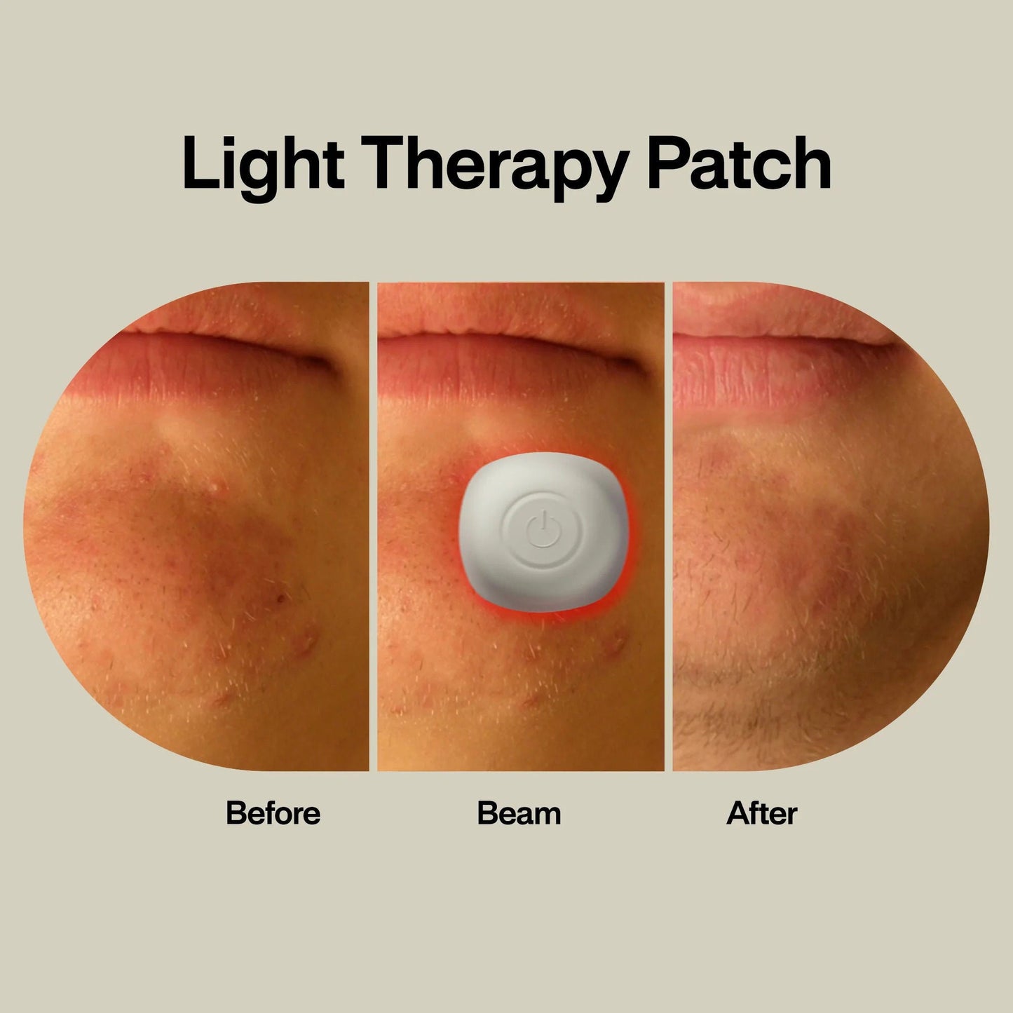 PATCH, THERAPY ACNE LIGHT (1/PK 96PK/CS)