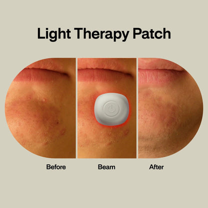 PATCH, THERAPY ACNE LIGHT (1/PK 96PK/CS)