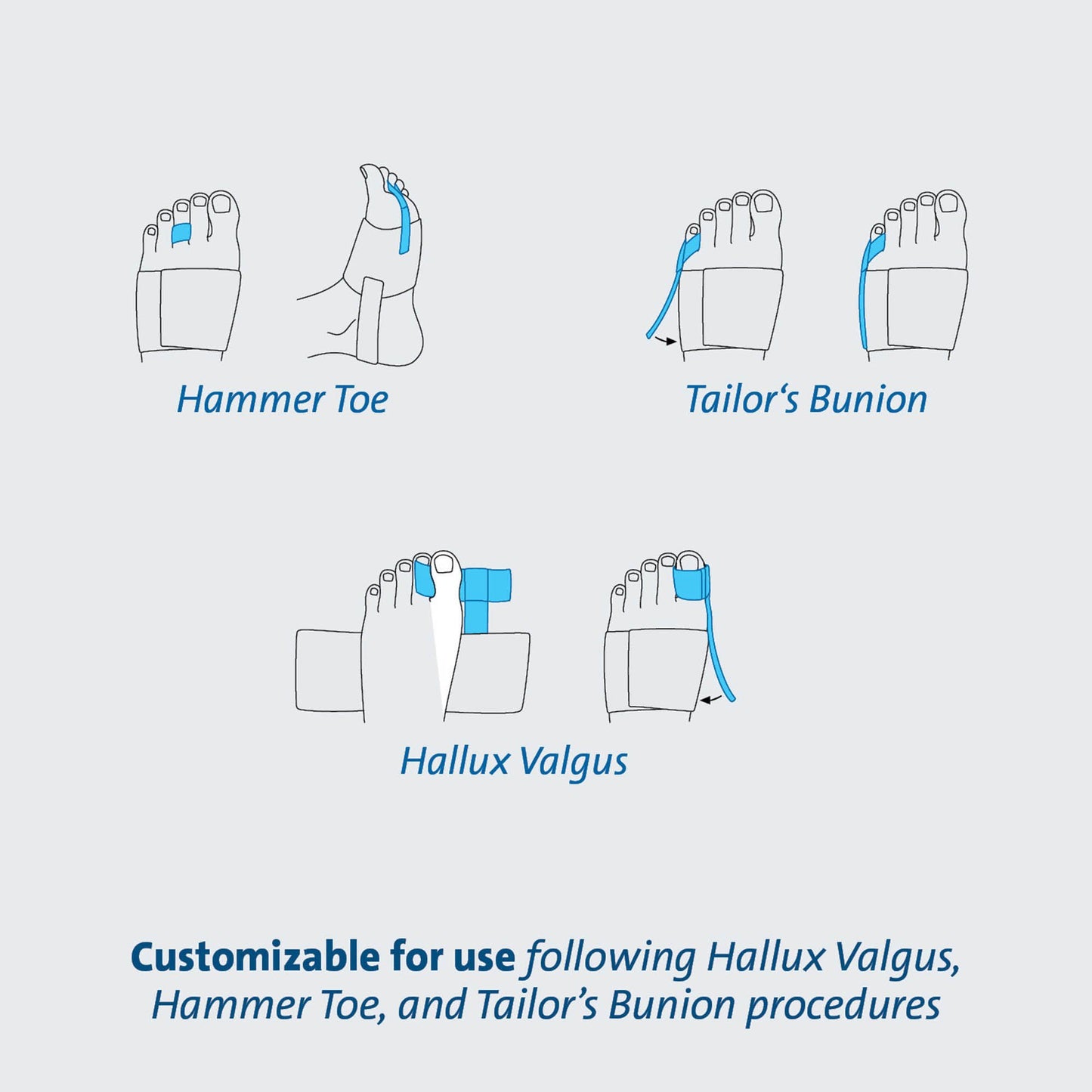 TOE SPLINT, ALIGNMENT (36/CS)