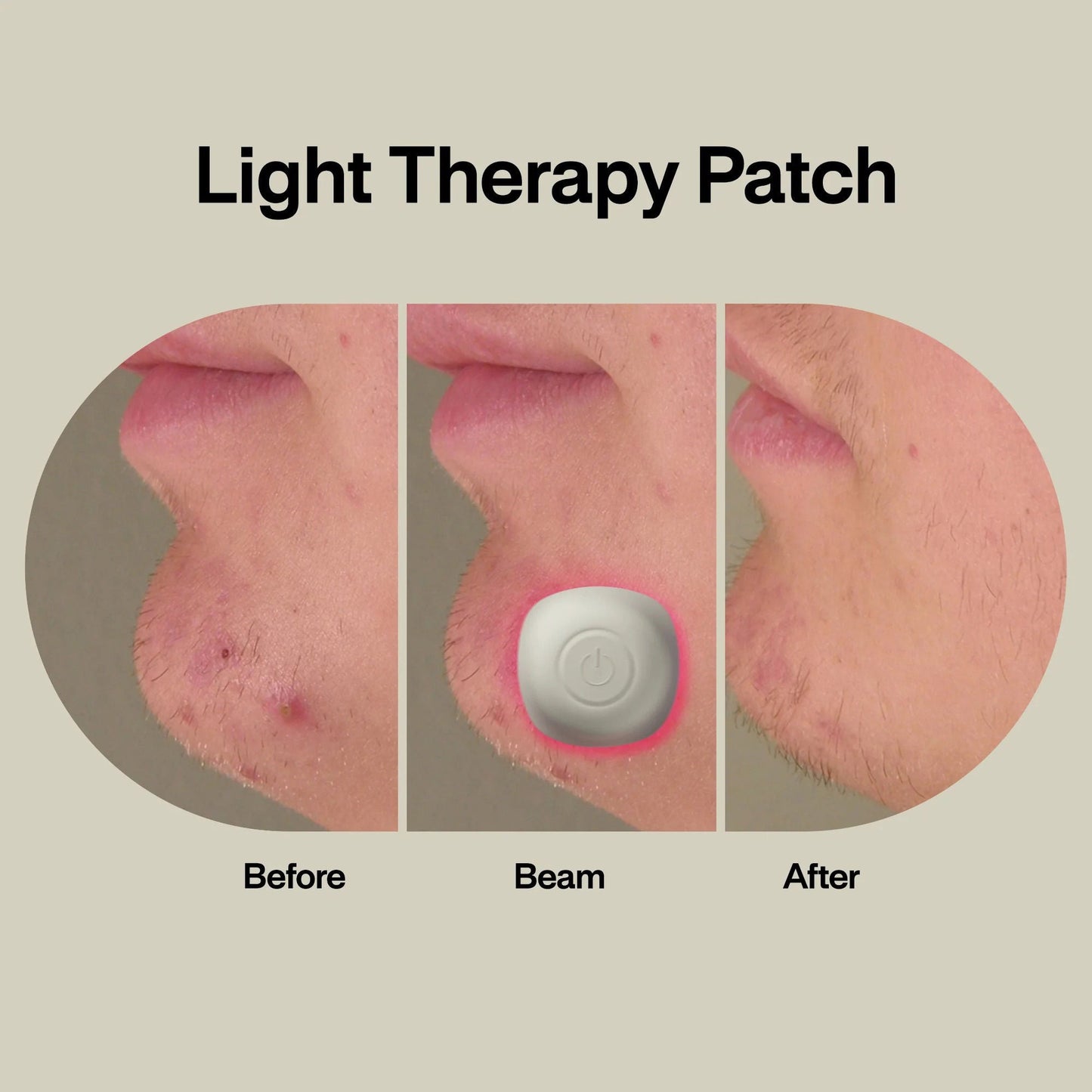 PATCH, THERAPY ACNE LIGHT (2/PK 96PK/CS)