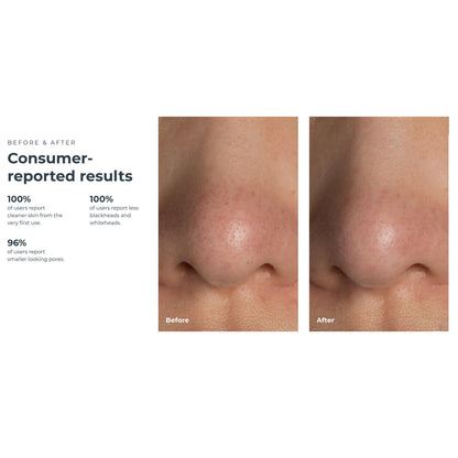 VACUUM, PORE BLACKHEAD REMOVERKIWI W/BLU LED LIGHT