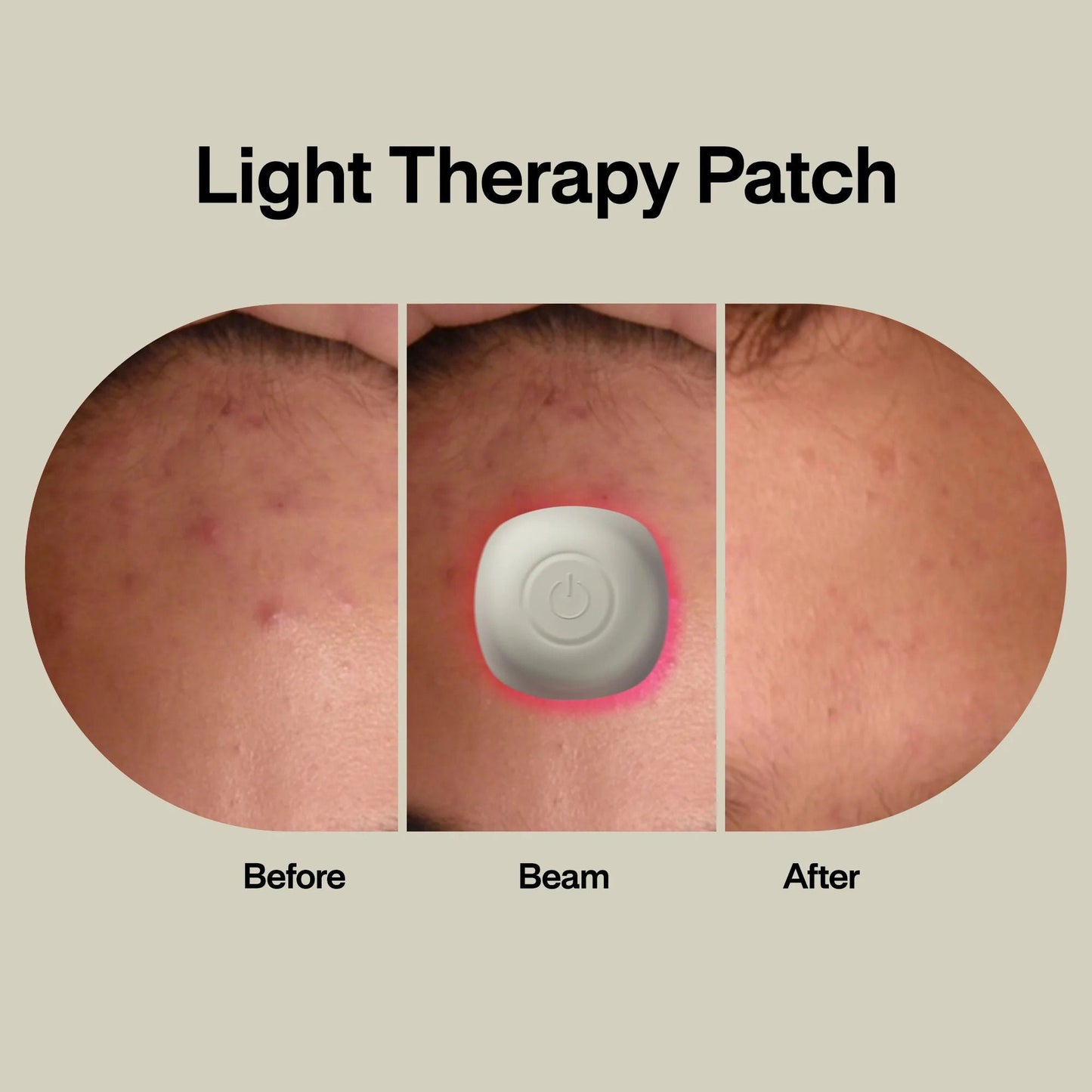 PATCH, THERAPY ACNE LIGHT (1/PK 96PK/CS)